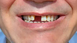Missing Teeth Image