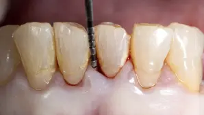 Periodontitis Gum Disease