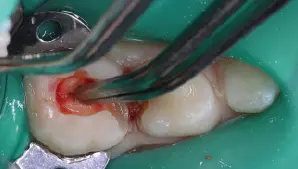 Pulp Removal Image