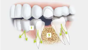 Reduced Bone Loss Dentures