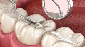 Sealing the Tooth Image