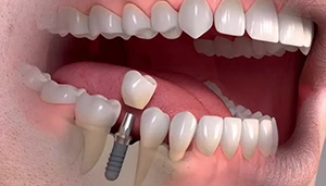 Single Tooth Implant in Gurgaon
