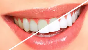 Teeth Whitening Treatment Gurgaon