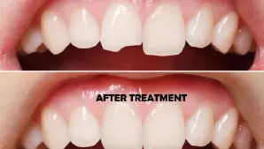Tooth Contouring Treatment Gurgaon