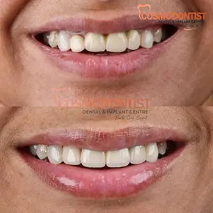 Teeth Fixing Image