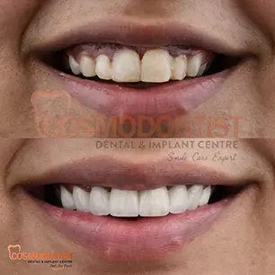 Teeth Whitening treatment image